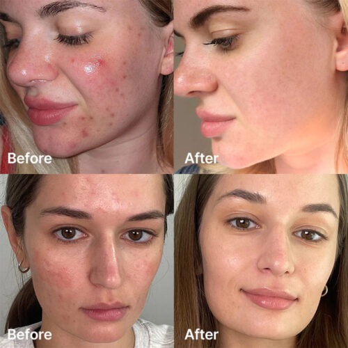 سرم ضد جوش سوکسینیک اسید مدی کیوب - Medicube Red Succinic Acid Serum
