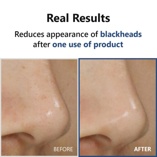 هایپر سرم لایه بردار 4 اسید ایزنتری - Isntree Hyper Acid4 AHA BHA PHA LHA 30 Serum