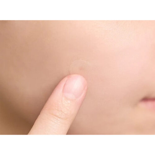 پچ ضد جوش تی تریکا سنتلا اسکین 1004 - Skin1004 Madagascar Centella Tea-Trica Spot Cover Patch